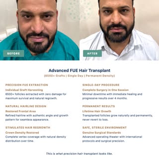 #bhopalcosmeticsurgery #hairtransplantsurgery #sehore #ashtaplasticsurgery #sehoreplasticsurgery