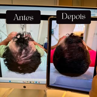 O resultado fala por si só!
Calvície não tem cura. E a gente não vai te prometer o que não existe.
O