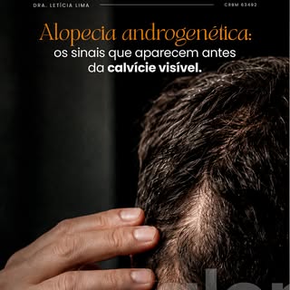 A alopecia androgenética costuma ser associada à imagem da calvície já instalada, mas o processo com