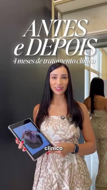 4 meses. Essa foi a evolução real de um paciente da LL Estética.

Queda de cabelo tem causa e tratam
