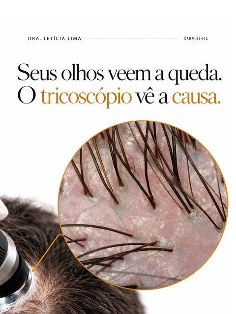 A calvície não começa quando você nota os primeiros fios no travesseiro. Ela começa muito antes, no 