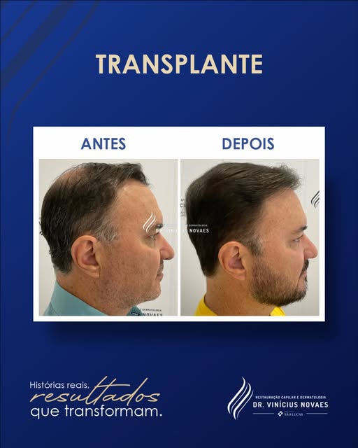 Cada transplante começa com um diagnóstico completo: análise do couro cabeludo, histórico e o tipo d