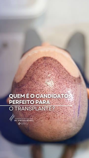 Quer saber quem é o paciente ideal para o transplante capilar? 🤔

O candidato perfeito é aquele pac