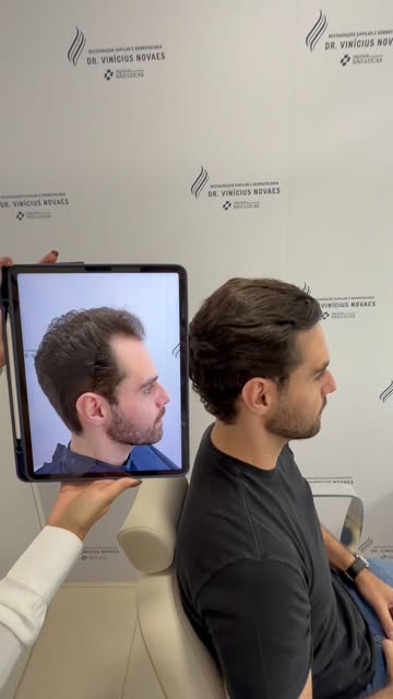 1 ano de transplante capilar. Um novo enquadramento para o rosto.
Neste caso, trabalhamos principalm