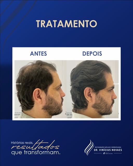 Antes: fios finos, queda visível e a autoestima baixa.

Depois: resultado de um tratamento capilar f