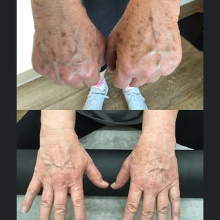 🌟 Say goodbye to sunspots with our advanced laser services! 🌟 Whether it's your face, arms, or any