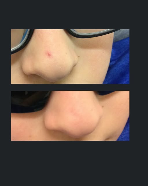Say goodbye to spider angiomas with our safe and effective Clarity II laser treatment! Experience sm