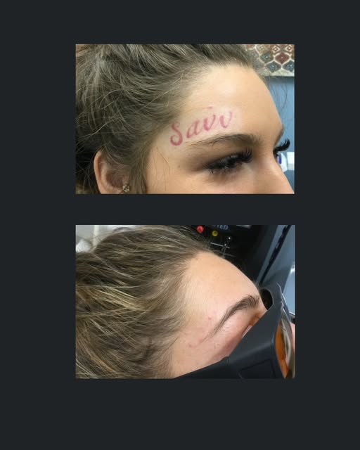 ✨ Check out this amazing before and after transformation of a red face tattoo removal! 🌟 The result