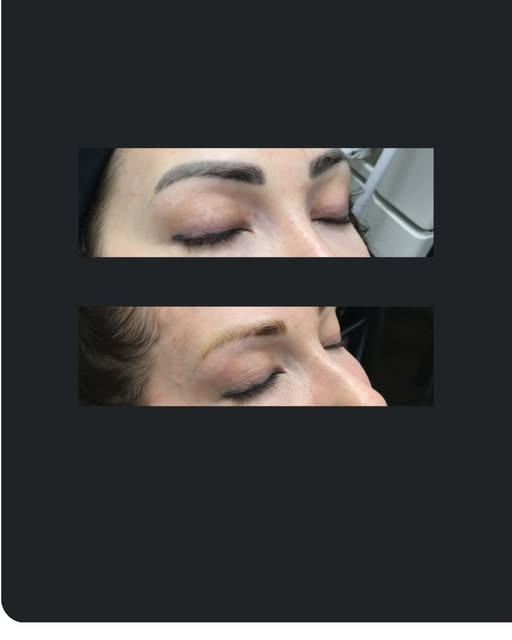 Transform your look with effective laser tattoo removal! 🌟 If you're struggling with dark colors fr