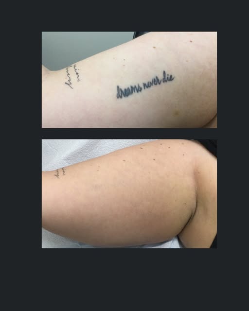Another s

✨ Another Successful Tattoo Removal! ✨ 

We're thrilled to share that we've helped anothe