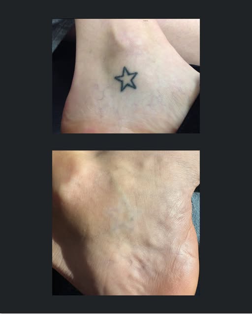 🌟✨ Success Story Alert! ✨🌟

Did you know that tattoo removal on the feet is like trying to untangl