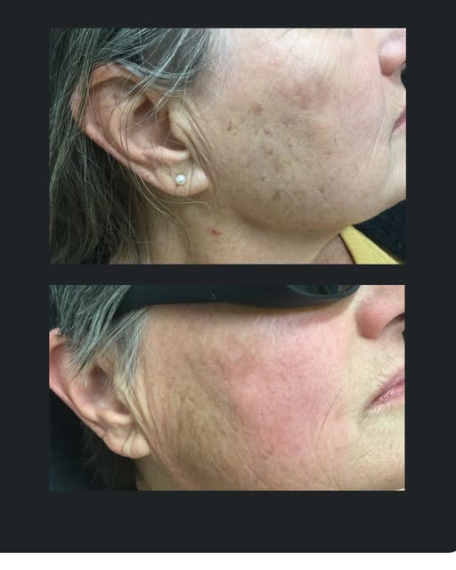 Ready to reveal your best skin? 🌟 Our Laser C Tone Facial is designed to help you say goodbye to un