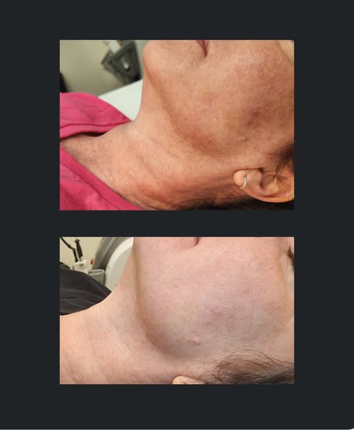 ✨ Check out this incredible transformation! ✨ 

Before and after just ONE treatment of microneedling