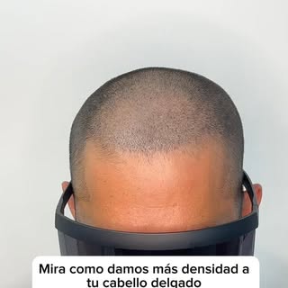 Mayor densidad al cabello delgado con la #micropigmentacioncapilar 💎🔝