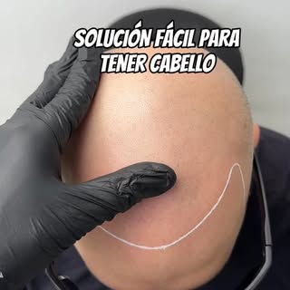 Solución fácil para tener cabello #micropigmentacioncapilar #reelsvideo #parati #fyp #viralvideo