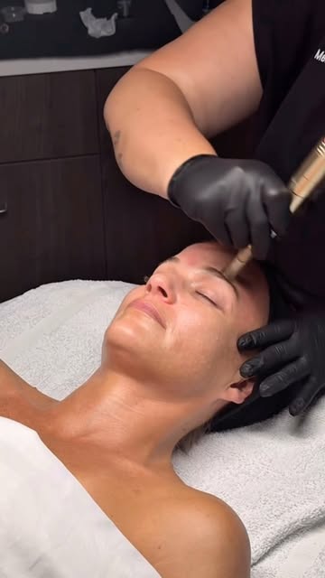 Microneedling is not to be slept on..

If you’re dealing with dull skin, scarring, uneven texture, o