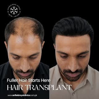 Your hair comeback starts now ✨

Advanced Hair Transplant solutions designed to restore your natural