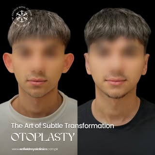 Confidence is in the details ✨

Otoplasty (Ear Reshaping Surgery) helps improve the shape, position,