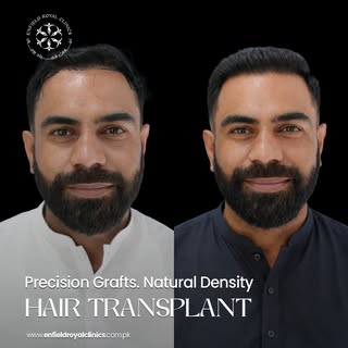 Hair loss may be common, but living with it doesn't have to be ✨

Hair Transplant is a proven soluti