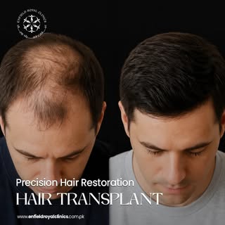 Your hairline doesn’t have to be a memory ✨

Hair Transplant is a long-lasting solution for hair los