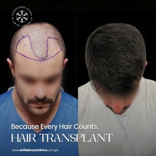 Don't let hair loss define your confidence ✨

A Hair Transplant is a permanent solution designed to 