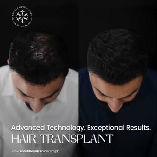 Your confidence deserves a fresh start ✨

A Hair Transplant is an advanced solution for restoring a 