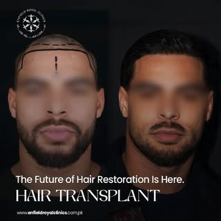 Ready to restore your natural hairline and confidence? ✨
Hair Transplant at Enfield Royal Clinic use