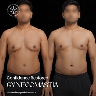 Struggling with enlarged male chest tissue? 💪
Gynecomastia treatment at Enfield Royal Clinic helps 