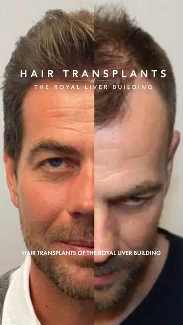 ✨ Fuller hair. Natural results. Confidence restored.

From receding hairlines to thinning areas, our