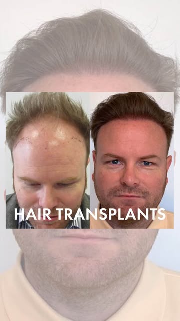 ✨ Natural-looking hair. Natural-looking results.

From receding hairlines to thinning areas, our FUE