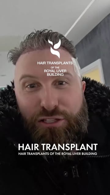 Hearing it straight from our patients says it all.

At Hair Transplants of The Royal Liver Building,