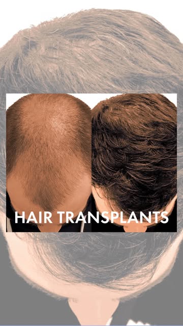 ✨ Natural-looking hair. Natural-looking results.

From receding hairlines to thinning areas, our FUE