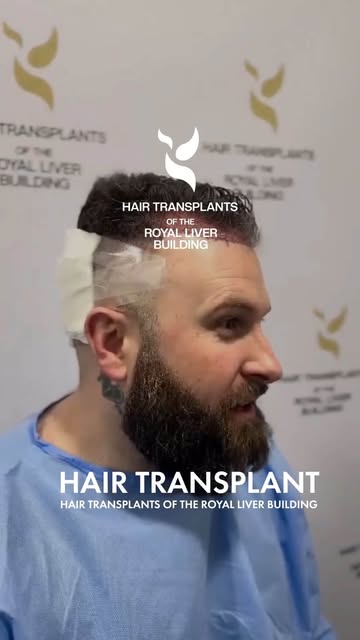 🎯 Precision. Placement. Natural density — hair restoration done properly.

Every graft counts. At H