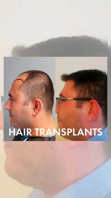 ✨ Natural-looking hair. Natural-looking results.

From receding hairlines to thinning areas, our FUE