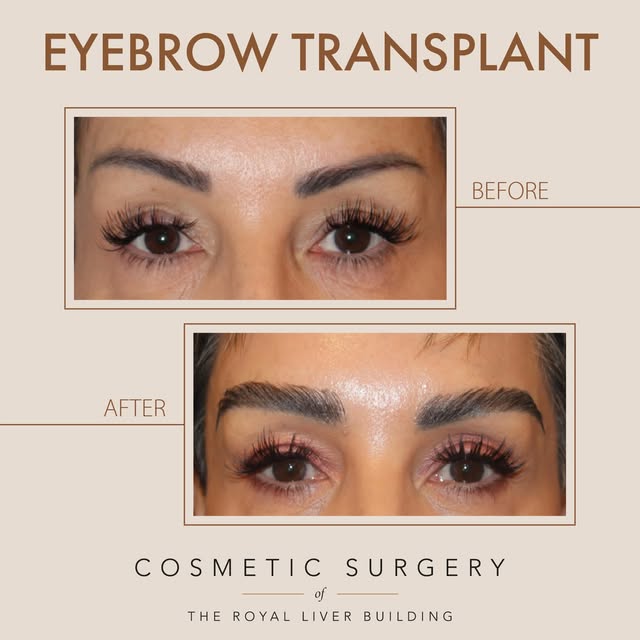 ✨ FULLER, NATURAL-LOOKING BROWS — DESIGNED FOR YOU ✨

Sparse brows from over-plucking, genetics, sca