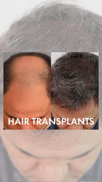 ✨ Natural-looking hair. Natural-looking results.

From receding hairlines to thinning areas, our FUE