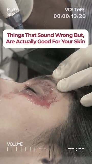 Poking thousands of tiny holes in your face sounds wrong. But it's actually one of the best things y