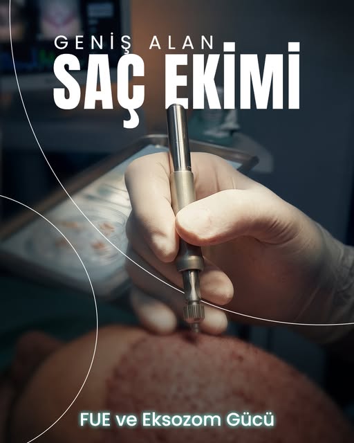 Geniş Açıklıklarda Bütüncül Tedavi Protokolü.

İleri derece saç dökülmelerinde FUE yöntemi ile yükse