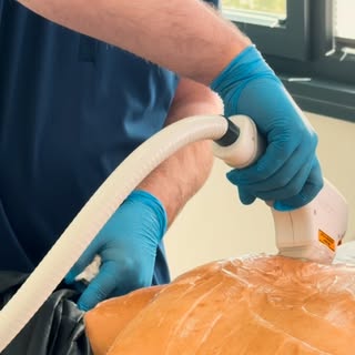 AKNE SONRASI OLUŞAN LEKELERDE KOMBİNE TEDAVİ

Hastamızın sırt bölgesinde akne ve inflamasyon sonrası