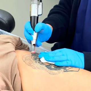 DÖVME SİLME

İstenmeyen dövmeler artık geçmişte kalmak zorunda değil.

Lazerle dövme silme işleminde
