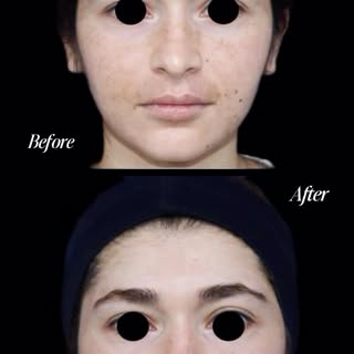 DERMAMELAN MASKE | ÖNCESİ & SONRASI

Hastamızın cilt tonundaki eşitsizliklerin ve leke görünümünün a