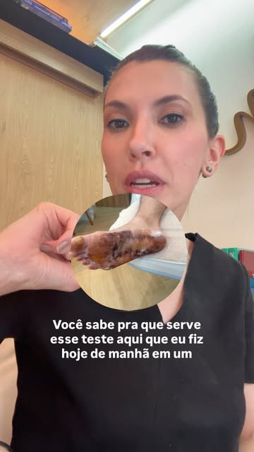 O teste de Minor ou iodo amido mostra a região de maior transpiração para que possamos fazer uma apl