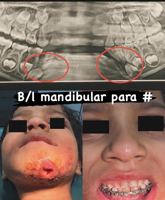 C/o b/l mandibular para symphysis fracture #close reduction under LA # oral surgery #Dr Aamir