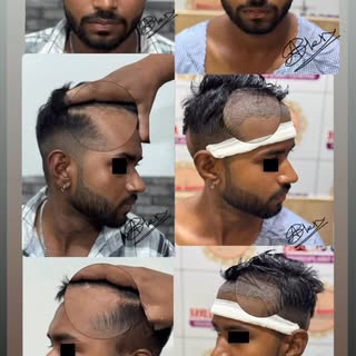 #Hair transplant #FUE #GRADE 2 MPB#DR AAMIR