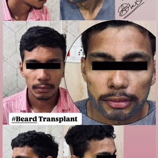 #Beard transplant # high density#4200 grafts implanted #FUE #aestheticsurgery #draamir # Meerut.