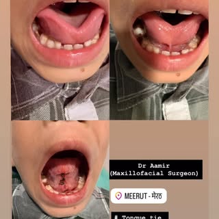 #tongue tie#frenuloplasty#dr Aamir #meerut
