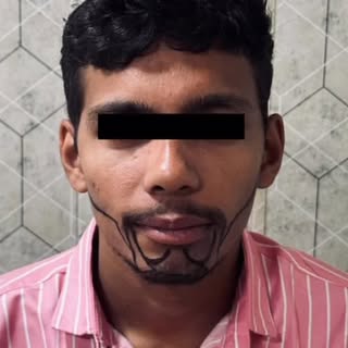 #beard transplant #transformation#resultsdraamir