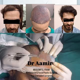 #Hair transplant
#FUE#macfac#results