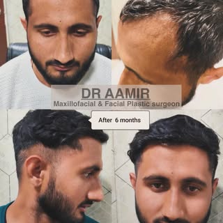 #results#dr Aamir #hair transplant #aestheticsurgerymeerur
