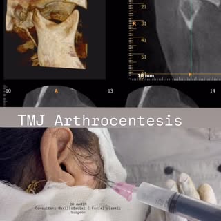 #TMJ artherocentesis# single puncture technique#idd# pain relieve t/t#draamirmeerut